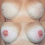 Pigementation réparatrice aréoles mammaires - Samia Daho