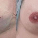 Dermopigmentation réparatrice des aréoles mamaires - Samia Daho