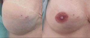 Dermopigmentation réparatrice des aréoles mamaires - Samia Daho