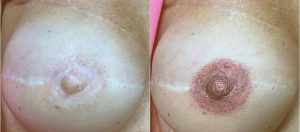 Dermopigmentation réparatrice des aréoles mammaires - Samia Daho