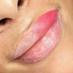 Détatouage des lèvres - Samia Daho