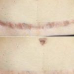 Dermopigmentation cicatrice (2) - Samia Daho